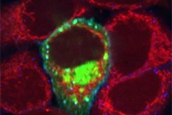 Breast cancer cells.