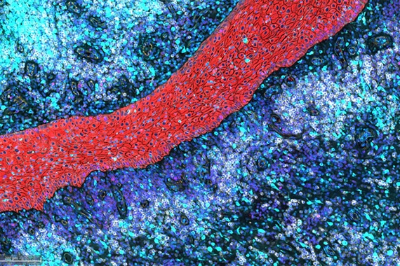 Multiplex immunofluorescence staining illustrating intradermal sheets of migrating stratified squamous epithelium and associated inflammatory response in Hidradenitis suppurativa.